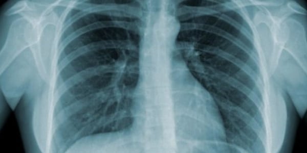 o-que-é-tuberculose-raio-x