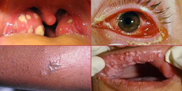 O-que-é-Gonorreia-e-quais-são-seus-sintomas-olhos-inchados-e-avermelhados-com-conjutivie-placas-amareladas-na-garganta-e-guela-ferimentos-e-lesões-na-pele-e-mucosas