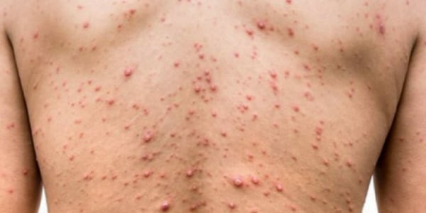 Pessoa-com-sintomas-de-Sífilis-manchas-vermlehas-na-superfície-do-corpo-na-pele