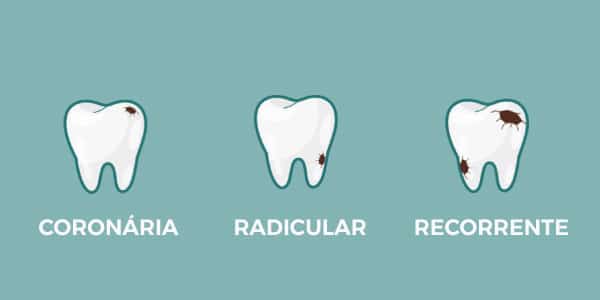 Tipos-de-cárie-coronária-radicular-e-recorrente