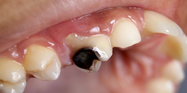 imagem-de-cárie-nos-dentes-a-mancha-preta-é-cárie-uma-doença-bacteriana