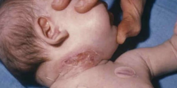 criança-com-pescoço-inchado-de-difteria