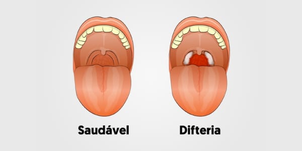 imagem-de-boca-saudável-e-boca-com-sintomas-de-difeteria-placas-branco-acinzentadas-nas-amigdalas